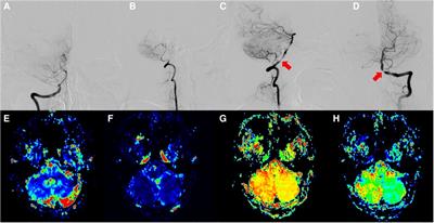 Case Report: Curative effect of OA-PICA protected bypass in severe PICA-complicated vertebral artery stenosis treatment: Results in 3 cases